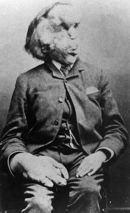 Famous People Associated with Leicester, Joseph Merrick